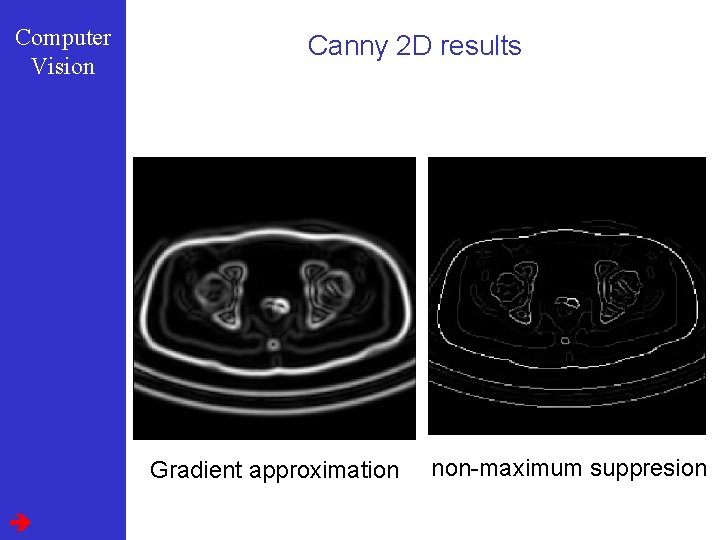 Computer Vision Canny 2 D results Gradient approximation non-maximum suppresion 