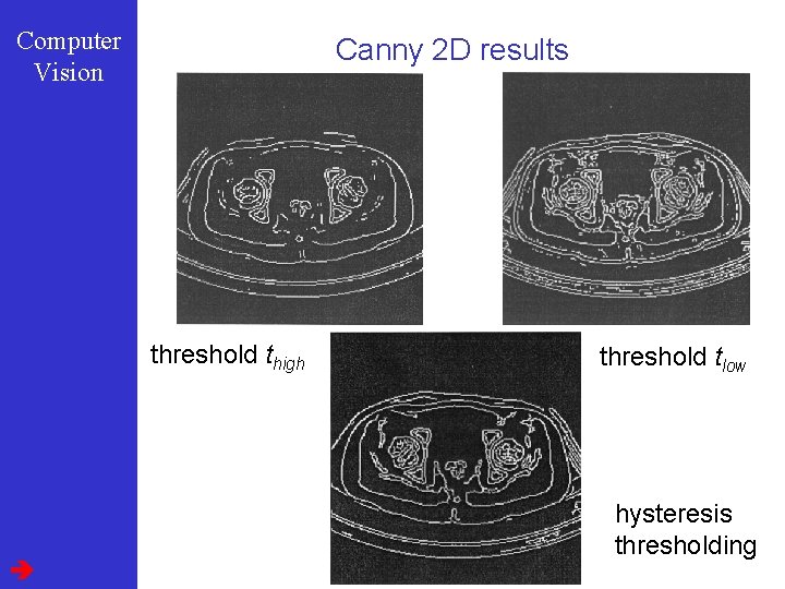 Computer Vision Canny 2 D results threshold thigh threshold tlow hysteresis thresholding 