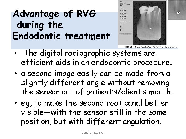 Advantage of RVG during the Endodontic treatment • The digital radiographic systems are efficient