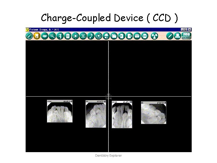 Charge-Coupled Device ( CCD ) Dentistry Explorer 