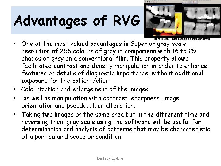 Advantages of RVG • One of the most valued advantages is Superior gray-scale resolution