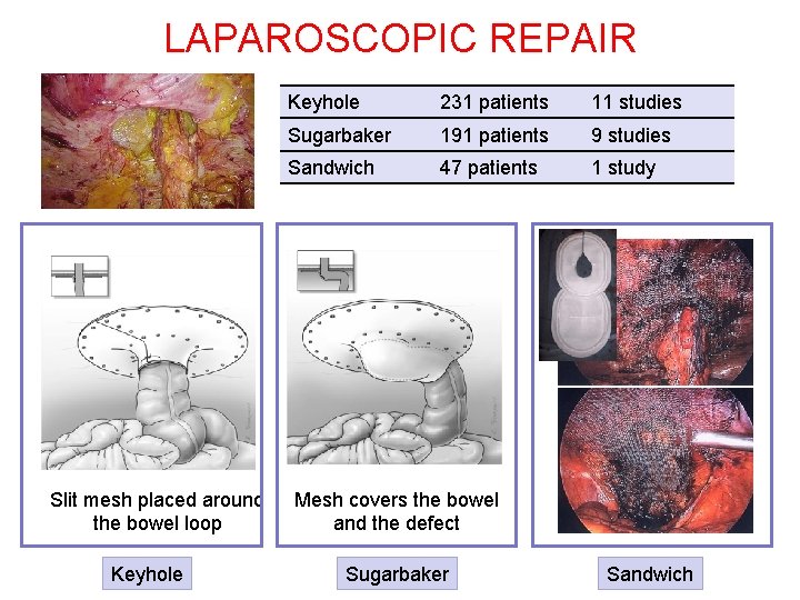 LAPAROSCOPIC REPAIR Slit mesh placed around the bowel loop Keyhole 231 patients 11 studies
