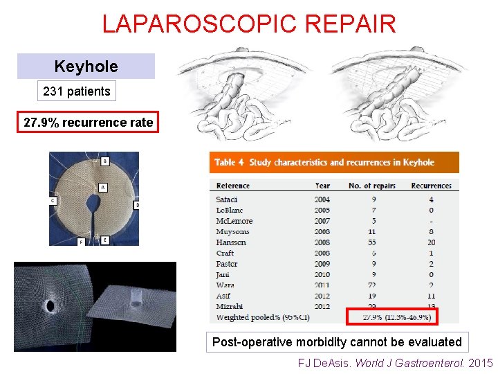 LAPAROSCOPIC REPAIR Keyhole 231 patients 27. 9% recurrence rate Post-operative morbidity cannot be evaluated