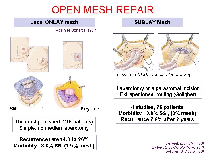 OPEN MESH REPAIR Local ONLAY mesh SUBLAY Mesh Rosin et Bonardi, 1977 Cuilleret (1990)