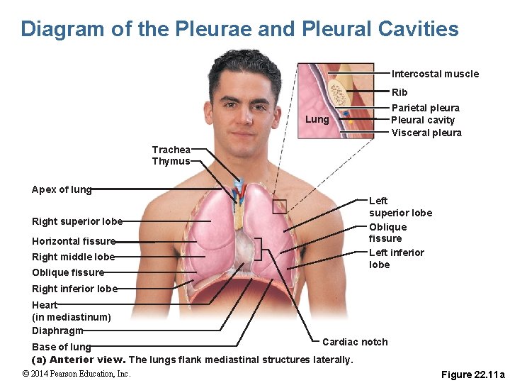 Diagram of the Pleurae and Pleural Cavities Intercostal muscle Rib Parietal pleura Pleural cavity