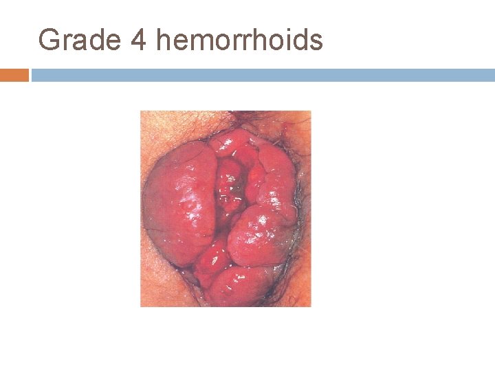 Grade 4 hemorrhoids 