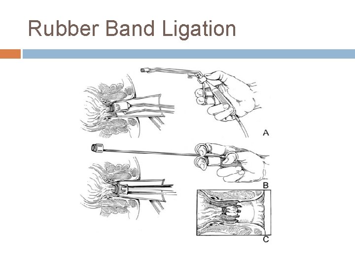 Rubber Band Ligation 