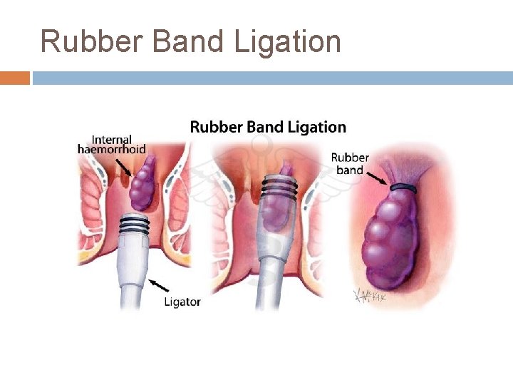 Rubber Band Ligation 