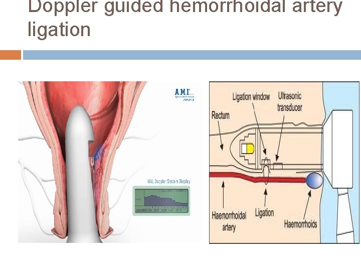 Doppler guided hemorrhoidal artery ligation 