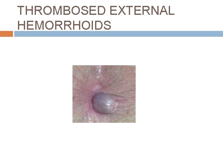 THROMBOSED EXTERNAL HEMORRHOIDS 