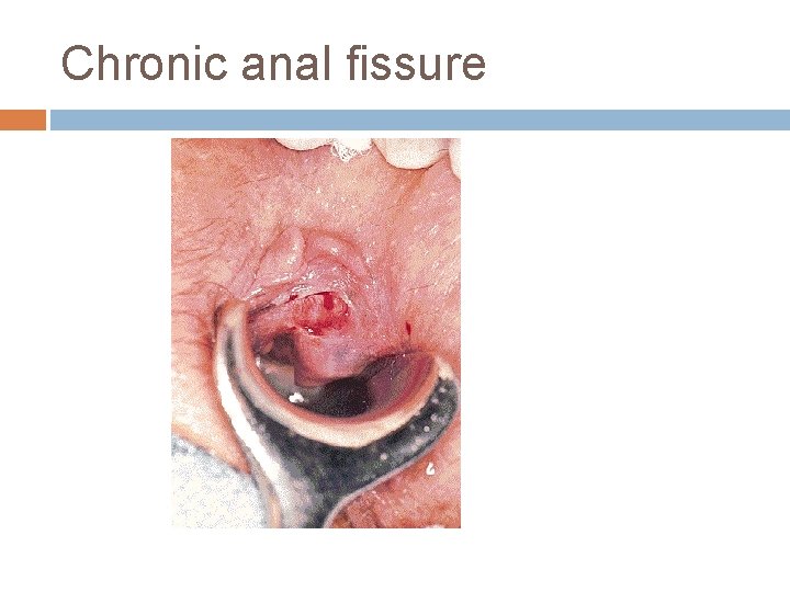 Chronic anal fissure 