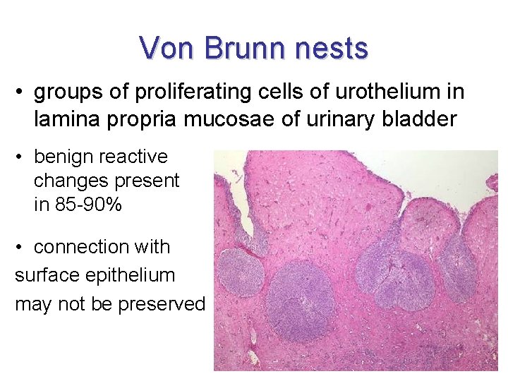Von Brunn nests • groups of proliferating cells of urothelium in lamina propria mucosae