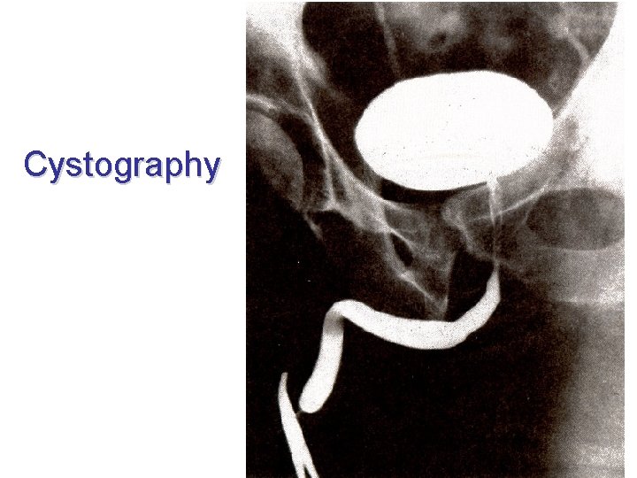 Cystography 