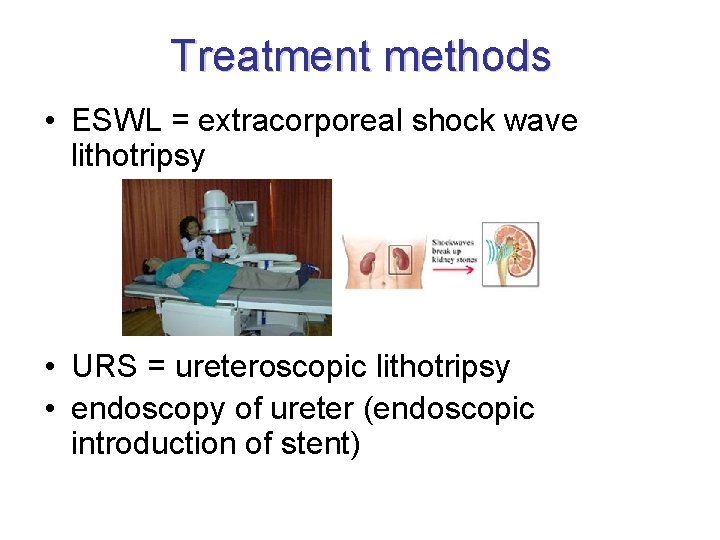 Treatment methods • ESWL = extracorporeal shock wave lithotripsy • URS = ureteroscopic lithotripsy