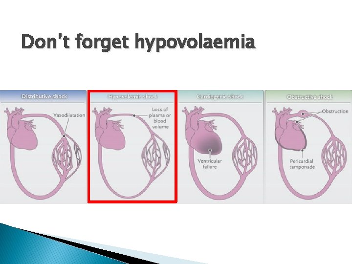 Don’t forget hypovolaemia 
