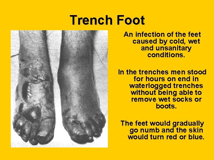 Trench Foot An infection of the feet caused by cold, wet and unsanitary conditions.