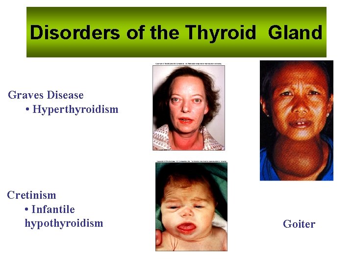 Disorders of the Thyroid Gland Graves Disease • Hyperthyroidism Cretinism • Infantile hypothyroidism Goiter