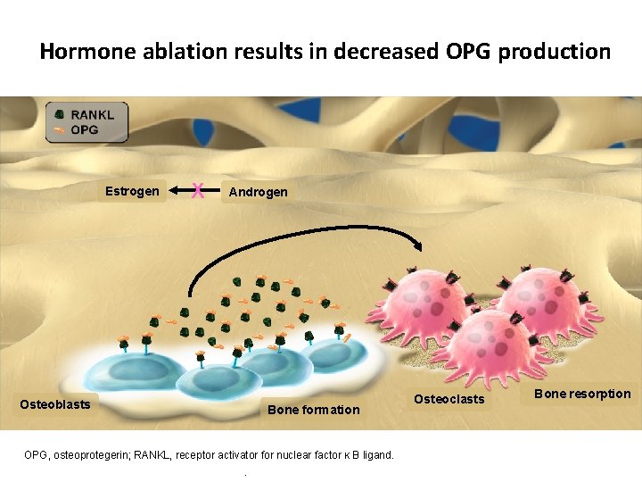 Hormone ablation results in decreased OPG production Estrogen X Androgen Osteoblasts Bone formation OPG,