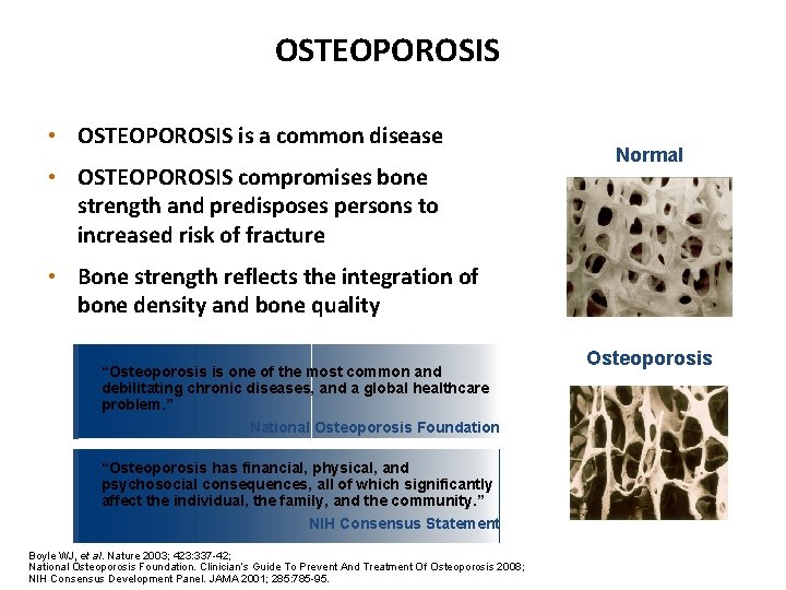 OSTEOPOROSIS • OSTEOPOROSIS is a common disease • OSTEOPOROSIS compromises bone strength and predisposes