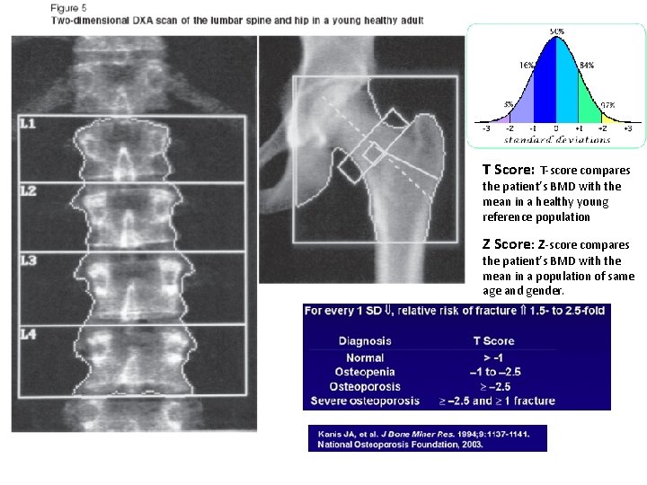 T Score: T-score compares the patient’s BMD with the mean in a healthy young