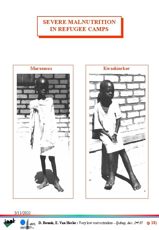 SEVERE MALNUTRITION IN REFUGEE CAMPS Marasmus Kwashiorkor 3/11/2021 iaal D. Bounie, E. Van Hecke
