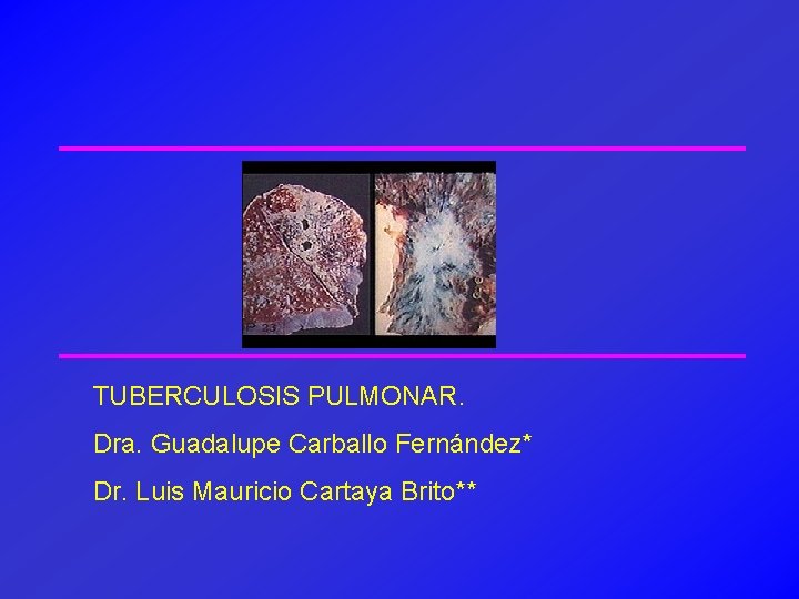 TUBERCULOSIS PULMONAR. Dra. Guadalupe Carballo Fernández* Dr. Luis Mauricio Cartaya Brito** 