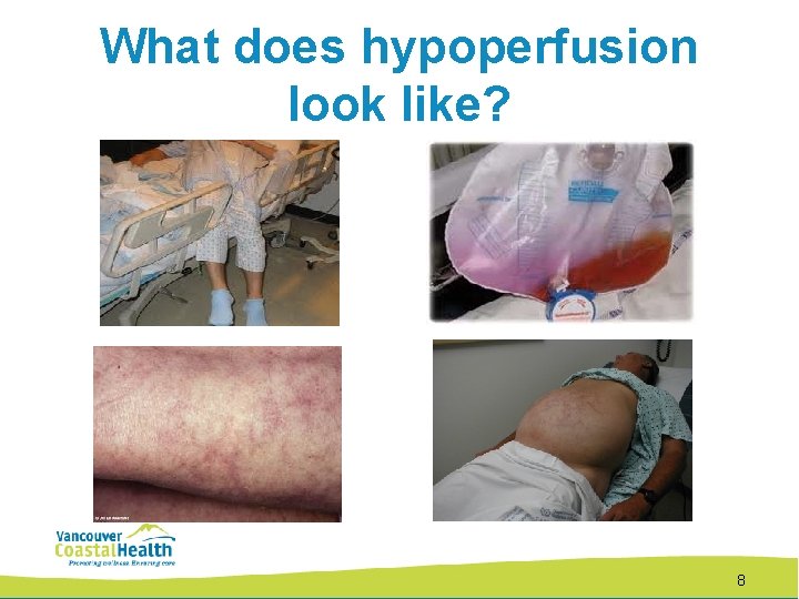 What does hypoperfusion look like? 8 