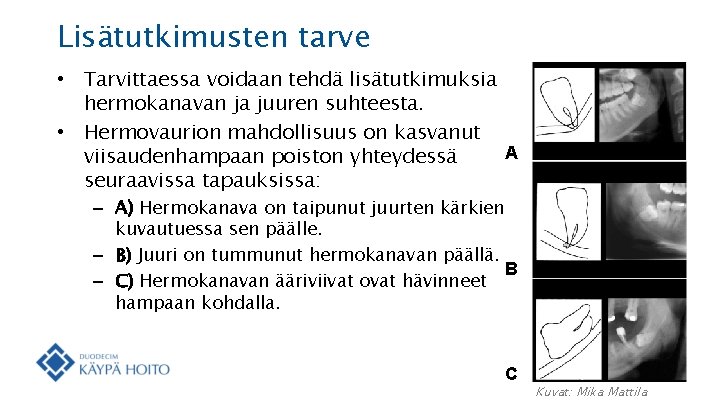 Lisätutkimusten tarve • Tarvittaessa voidaan tehdä lisätutkimuksia hermokanavan ja juuren suhteesta. • Hermovaurion mahdollisuus