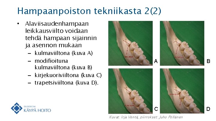 Hampaanpoiston tekniikasta 2(2) • Alaviisaudenhampaan leikkausviilto voidaan tehdä hampaan sijainnin ja asennon mukaan –