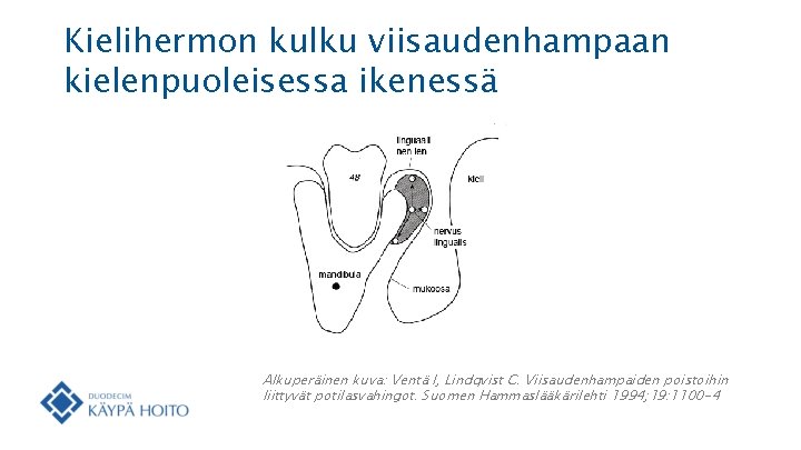 Kielihermon kulku viisaudenhampaan kielenpuoleisessa ikenessä Alkuperäinen kuva: Ventä I, Lindqvist C. Viisaudenhampaiden poistoihin liittyvät