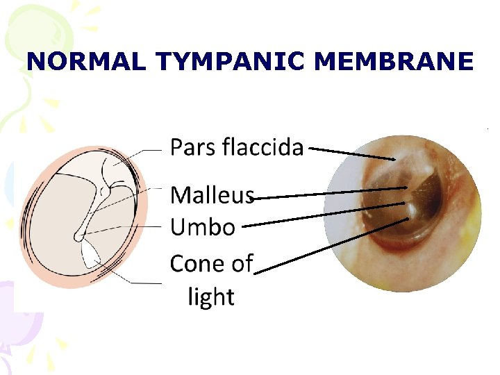 NORMAL TYMPANIC MEMBRANE NORMAL TYMPANIC MEMBRANE