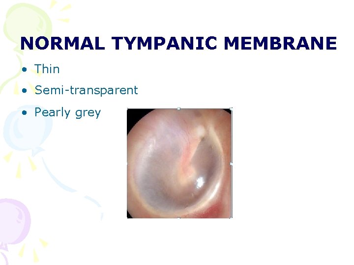 NORMAL TYMPANIC MEMBRANE • Thin • Semi-transparent • Pearly grey NORMAL TYMPANIC MEMBRANE • Thin • Semi-transparent • Pearly grey