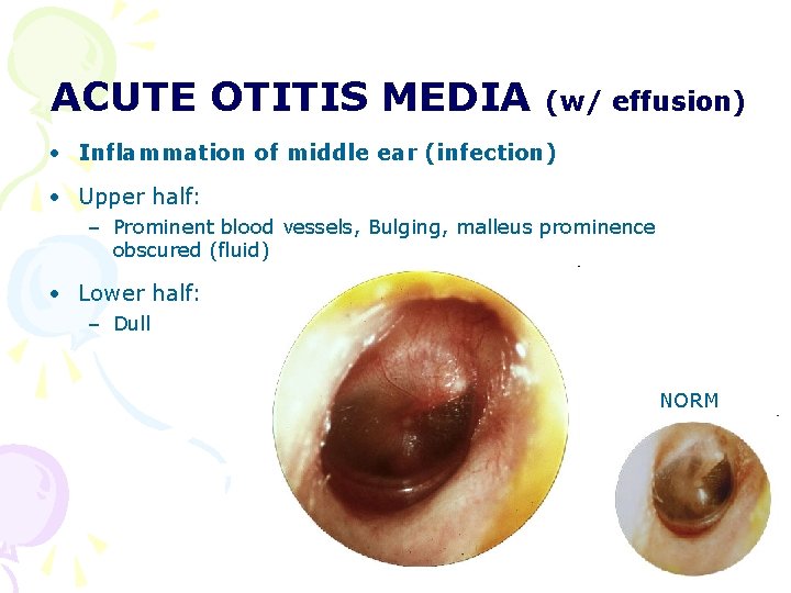 ACUTE OTITIS MEDIA (w/ effusion) • Inflammation of middle ear (infection) • Upper half: ACUTE OTITIS MEDIA (w/ effusion) • Inflammation of middle ear (infection) • Upper half:
