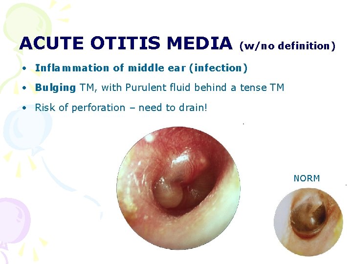 ACUTE OTITIS MEDIA (w/no definition) • Inflammation of middle ear (infection) • Bulging TM, ACUTE OTITIS MEDIA (w/no definition) • Inflammation of middle ear (infection) • Bulging TM,