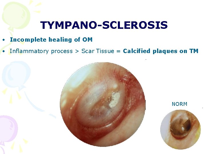 TYMPANO-SCLEROSIS • Incomplete healing of OM • Inflammatory process > Scar Tissue = Calcified TYMPANO-SCLEROSIS • Incomplete healing of OM • Inflammatory process > Scar Tissue = Calcified