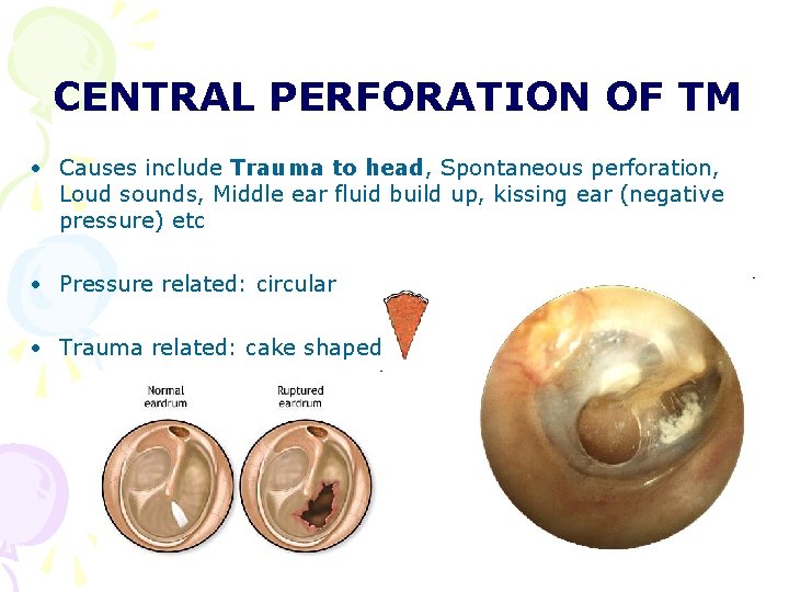 CENTRAL PERFORATION OF TM • Causes include Trauma to head, Spontaneous perforation, Loud sounds, CENTRAL PERFORATION OF TM • Causes include Trauma to head, Spontaneous perforation, Loud sounds,