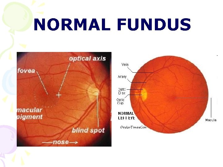 NORMAL FUNDUS NORMAL FUNDUS