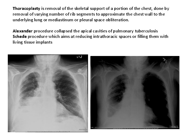 Thoracoplasty is removal of the skeletal support of a portion of the chest, done