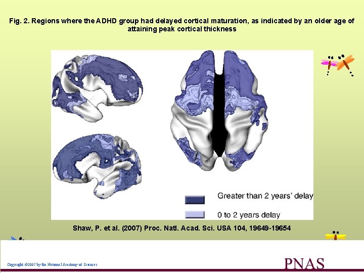 Fig. 2. Regions where the ADHD group had delayed cortical maturation, as indicated by