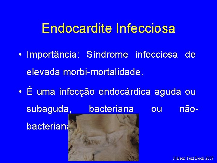 Endocardite Infecciosa • Importância: Síndrome infecciosa de elevada morbi-mortalidade. • É uma infecção endocárdica