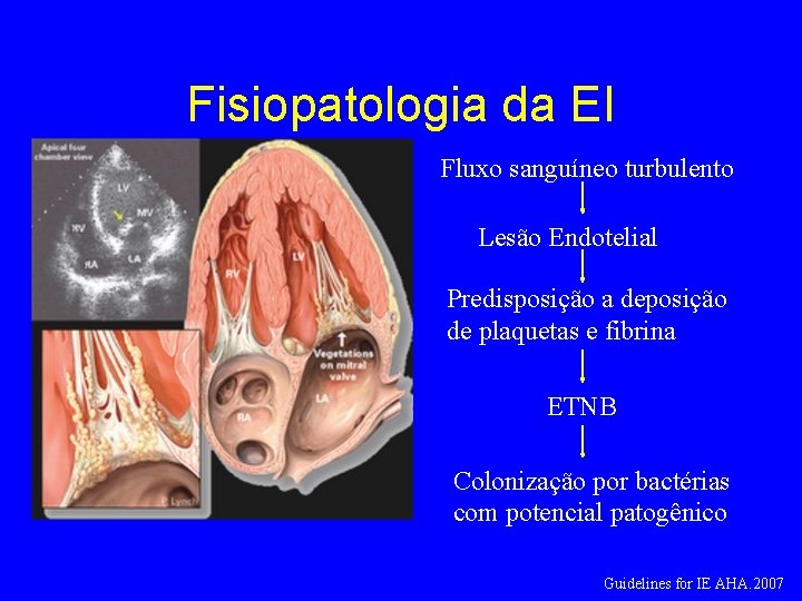 Fisiopatologia da EI Fluxo sanguíneo turbulento Lesão Endotelial Predisposição a deposição de plaquetas e