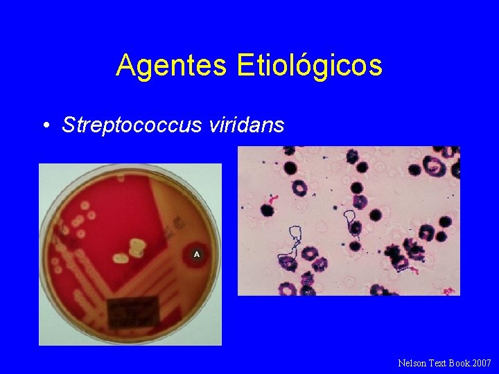 Agentes Etiológicos • Streptococcus viridans Nelson Text Book. 2007 