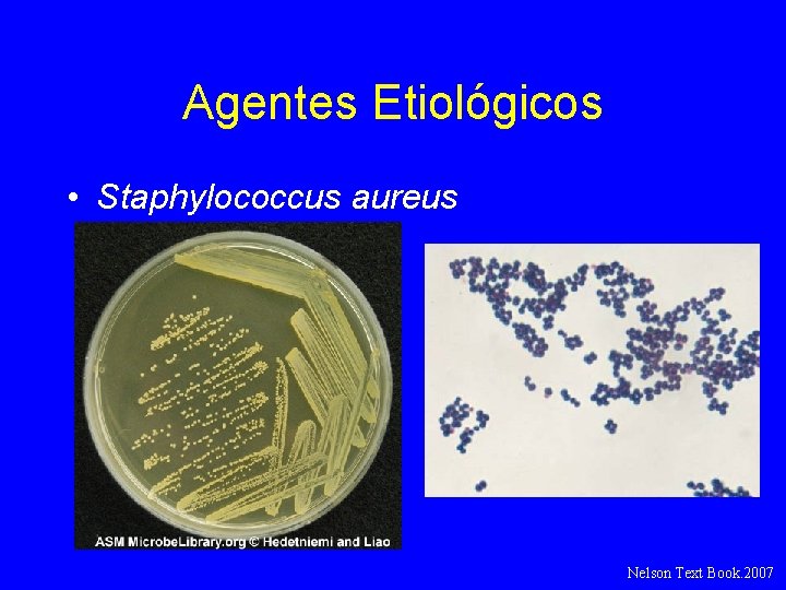 Agentes Etiológicos • Staphylococcus aureus Nelson Text Book. 2007 