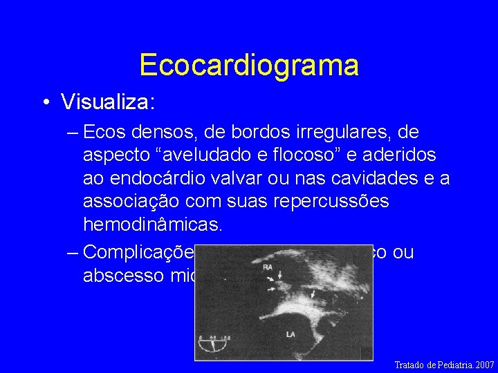 Ecocardiograma • Visualiza: – Ecos densos, de bordos irregulares, de aspecto “aveludado e flocoso”