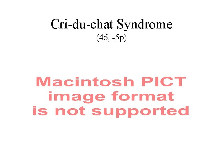 Cri-du-chat Syndrome (46, -5 p) 