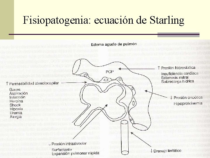 Fisiopatogenia: ecuación de Starling Fisiopatogenia: ecuación de Starling