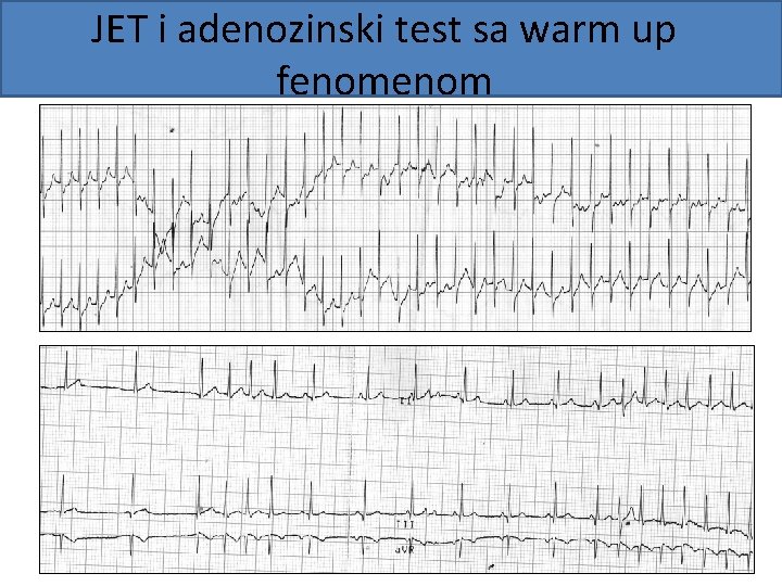 JET i adenozinski test sa warm up fenom 