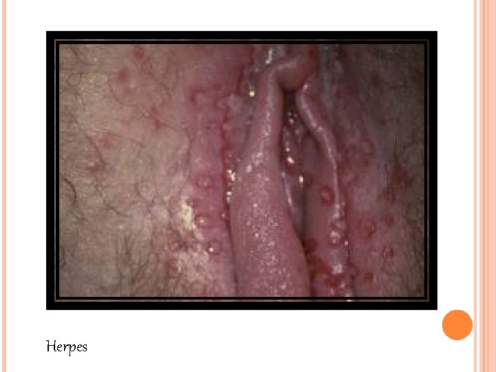 Herpes Herpes