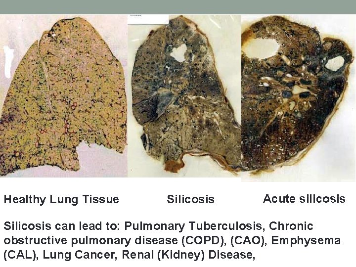 Healthy Lung Tissue Silicosis Acute silicosis Silicosis can lead to: Pulmonary Tuberculosis, Chronic obstructive
