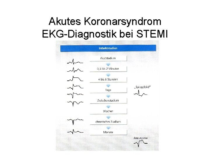 Akutes Koronarsyndrom EKG-Diagnostik bei STEMI 